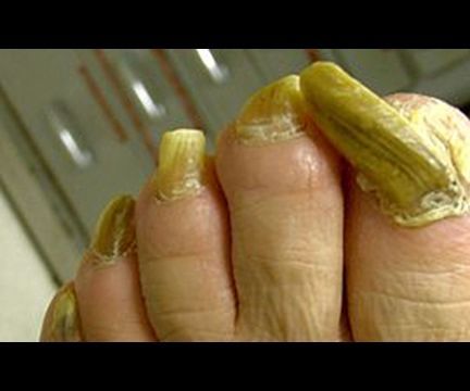 Cure for Fungal Nail Infection