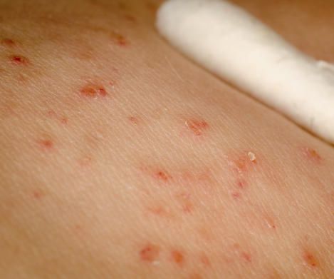 Cyst Under Armpit , As Well As the Sort of Issue, It Creates