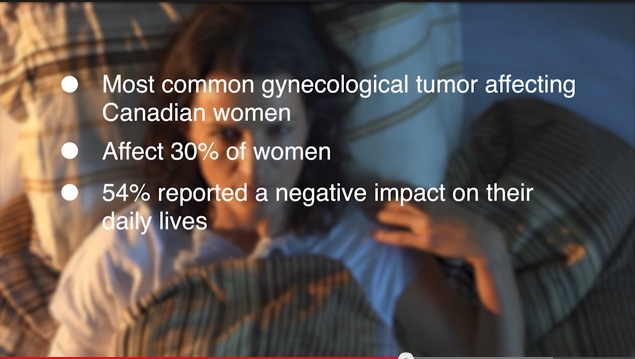 New Treatment for Uterine Fibroids