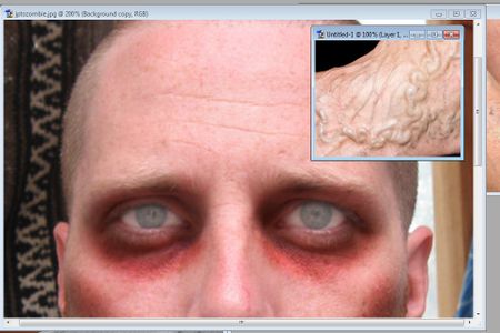 Step Five: Thrombosis, or Blood Clotted Veins.