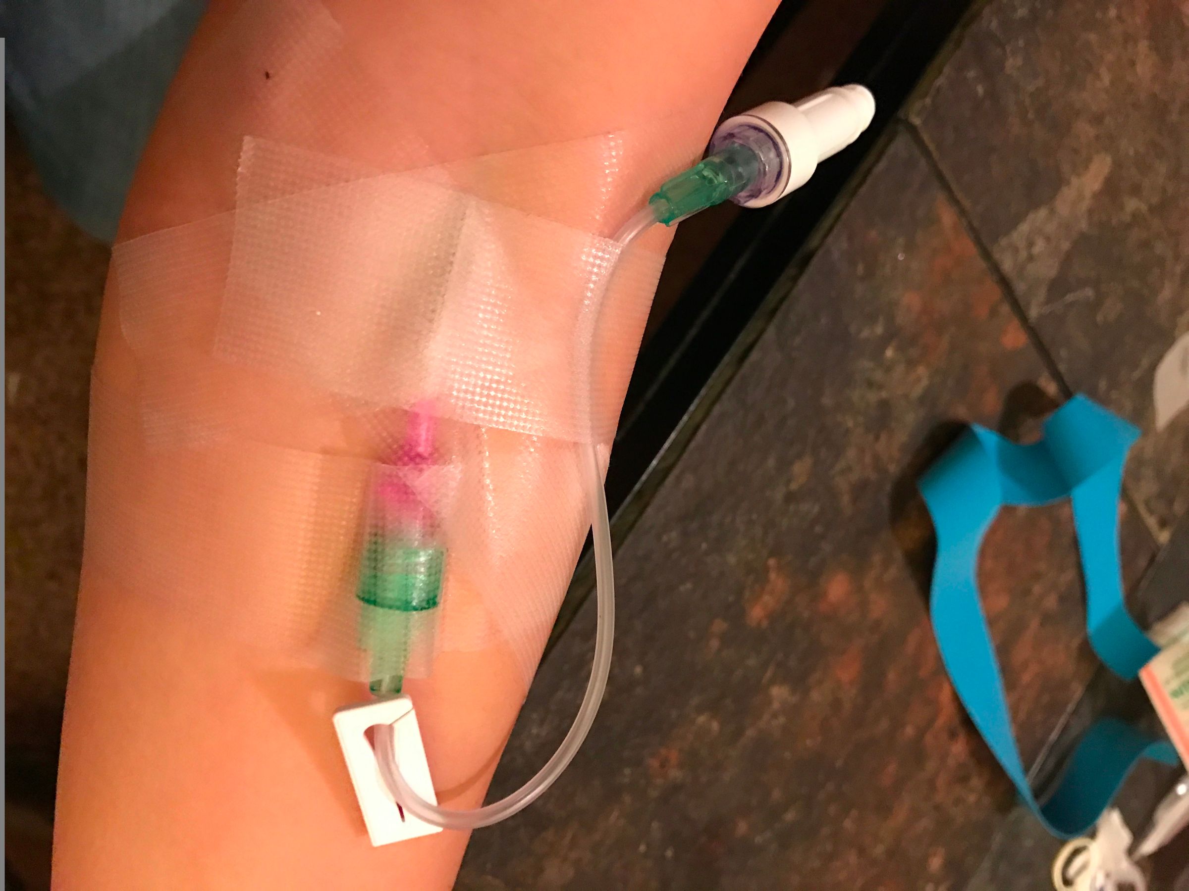 How To Insert Iv Catheter Successfully
