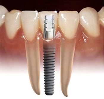 Are Dental Implants Painful?