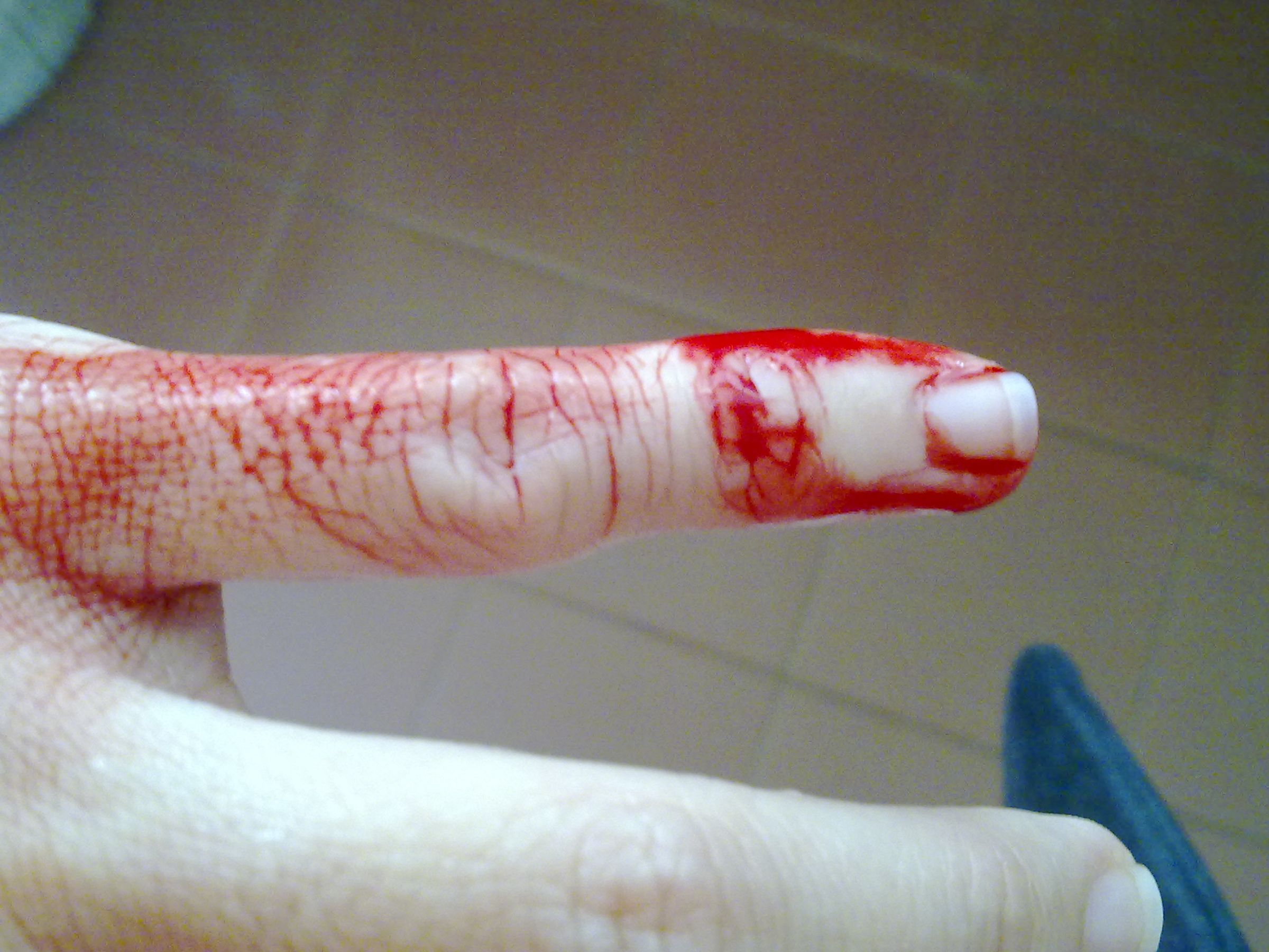 Stop That Bleeding!!!!