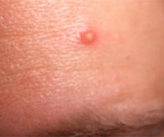 How to Temporarily Get Rid of the Redness of Pimpils / Zits.