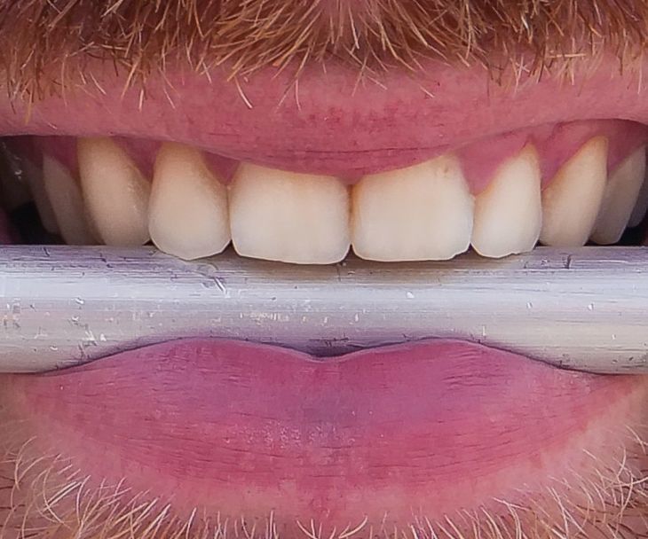 Tandentelefoon - Kan Je Horen Met Je Tanden? (Nederlands/Dutch)