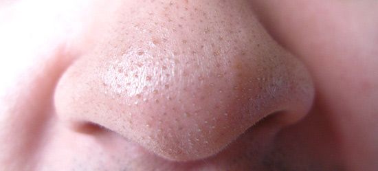 Black Head Remover