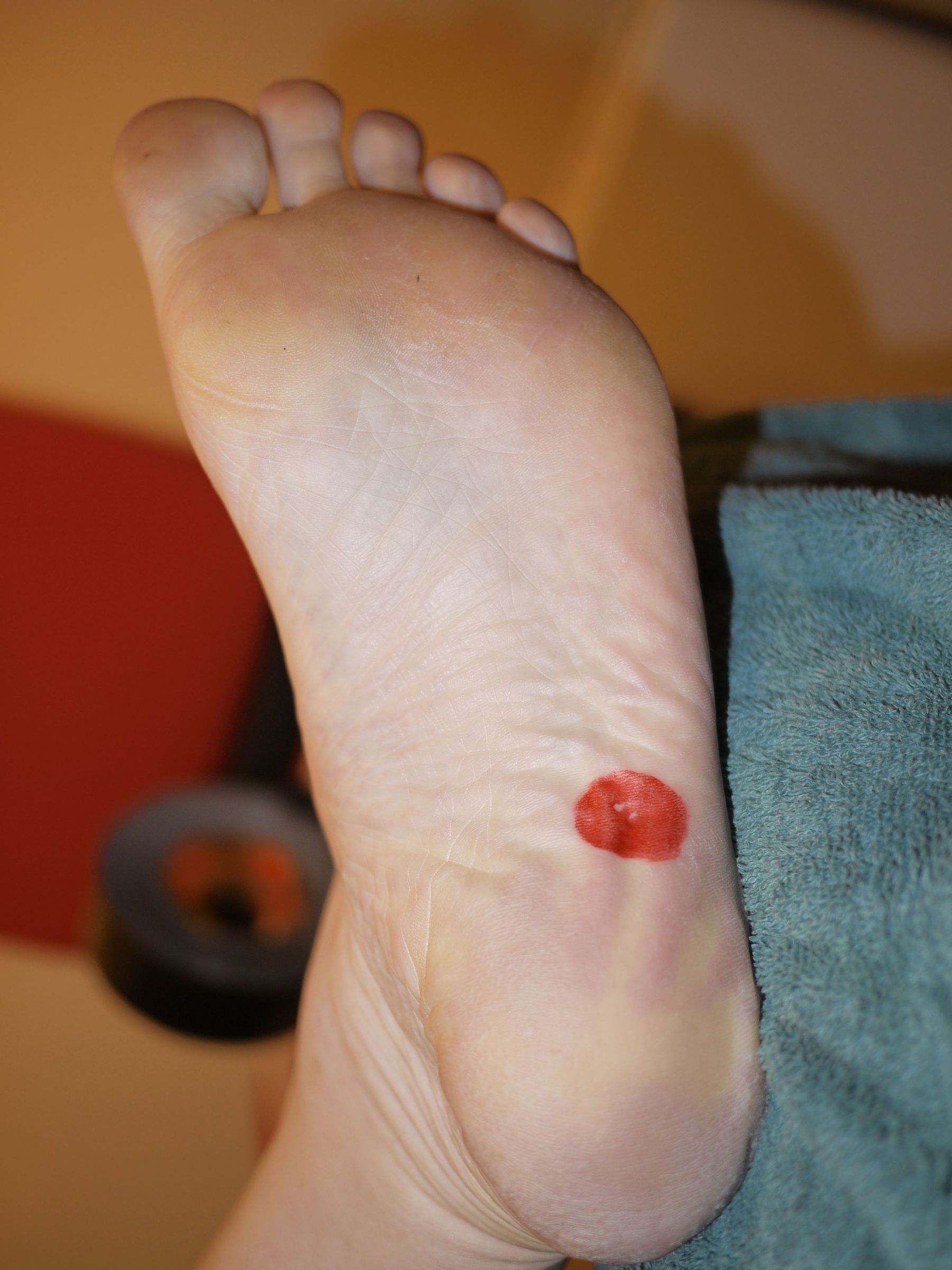 Effective Plantar Wart / Verruca Cure Using Duct Tape Occlusion Therapy (DTOT)