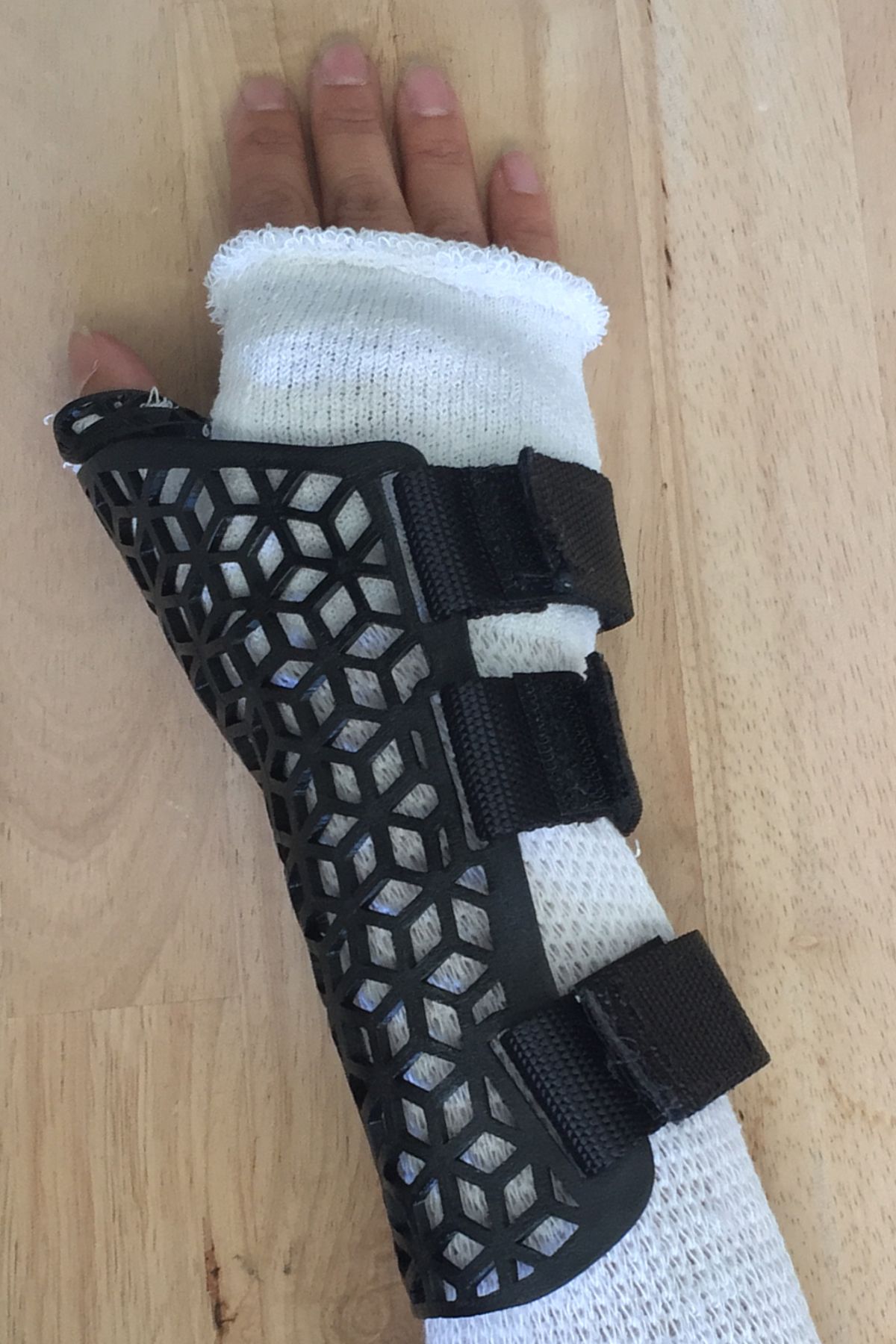 3D Printed - Thumb + Wrist Immobilization Brace : 5 Steps (with ...