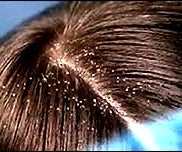 Get Rid of Dandruff, Grow Hair or Cure Baldness