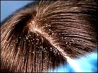 Get Rid of Dandruff, Grow Hair or Cure Baldness