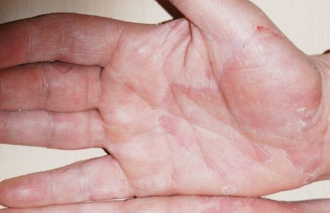 How to Heal Contact Eczema With Bacon