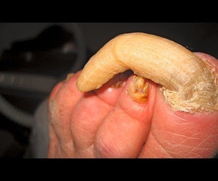 Treatment for Fungal Nail Infection