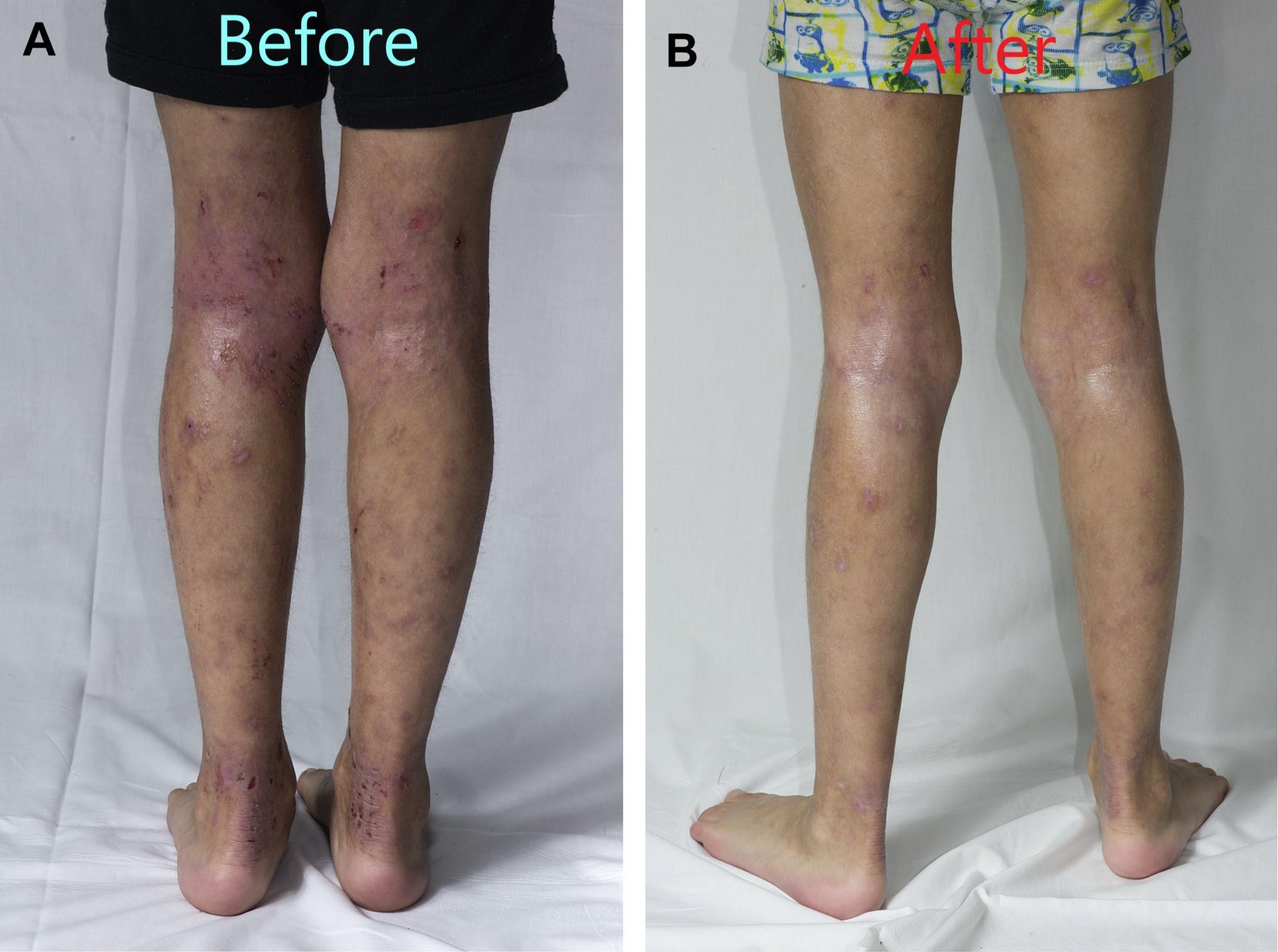 Preventing Eczema Wet Wrap Procedure 7 Steps Instructables