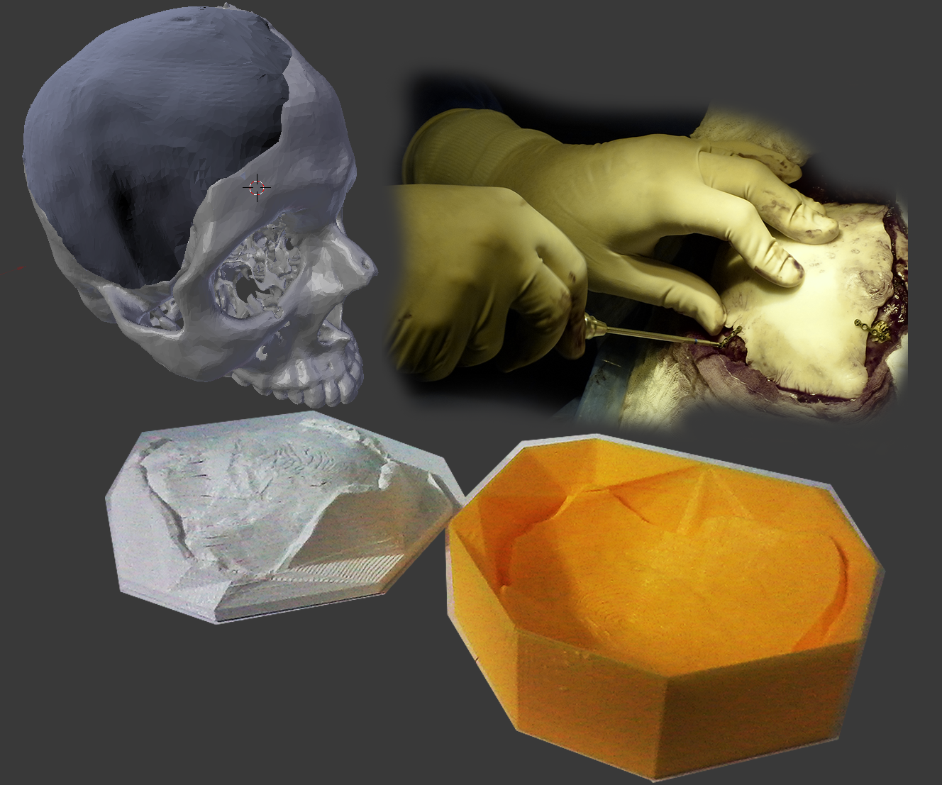 Surgery + Fully 3D Printed Mold