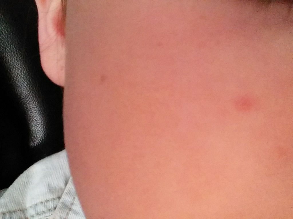 Bye to spots using salt and water