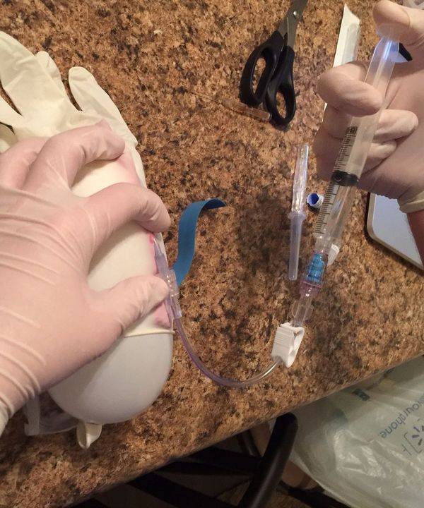How to Insert a Saline Lock