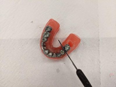 Remove Metal Teeth