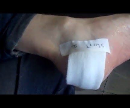 How to Properly apply a wound dressing