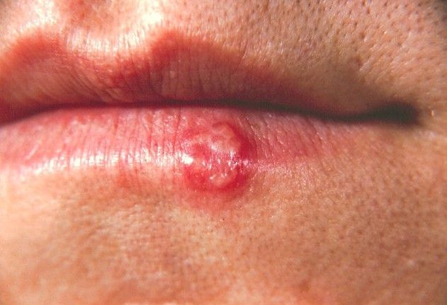 Get Rid of Cold Sores Faster and Prevent Spreading.