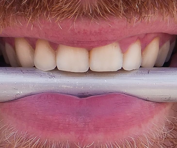 Teeth Headphone - Can You Hear With Your Teeth? 