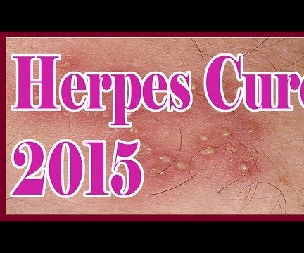 Herpes Pictures ►Herpes Cure 2015