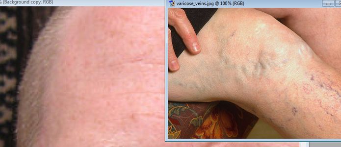 Step Five: Thrombosis, or Blood Clotted Veins.