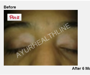 Treatment Options for Vitiligo White Patches in USA and UK