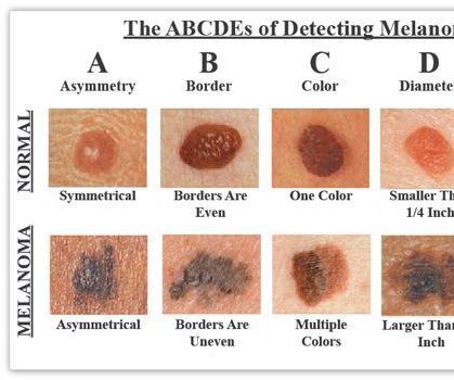 The 'ABCDE' of Detecting Skin Melanoma and Matlab.