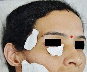 Use of 3D printing in facial fat transfer