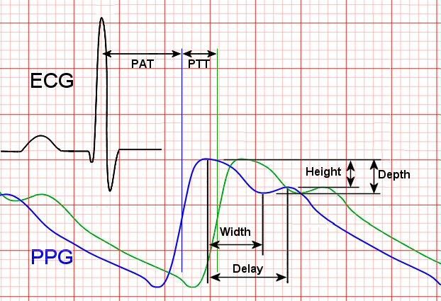 ECG With PPG Using Arduino : 9 Steps (with Pictures) - Instructables