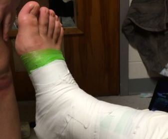 How to Tape an Ankle 