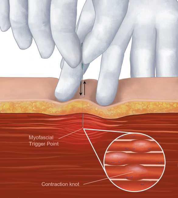 NeedleSense: Real-Time Guided Dry Needling for Physiotherapists