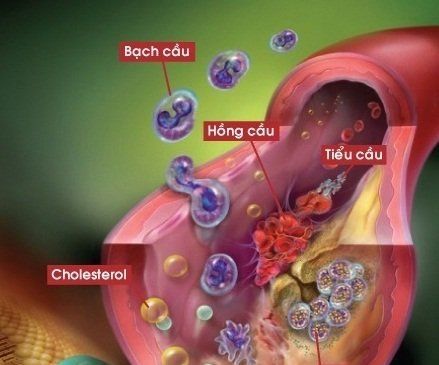 Cao Mỡ Máu Và Điều Trị Bằng Dinh Dưỡng