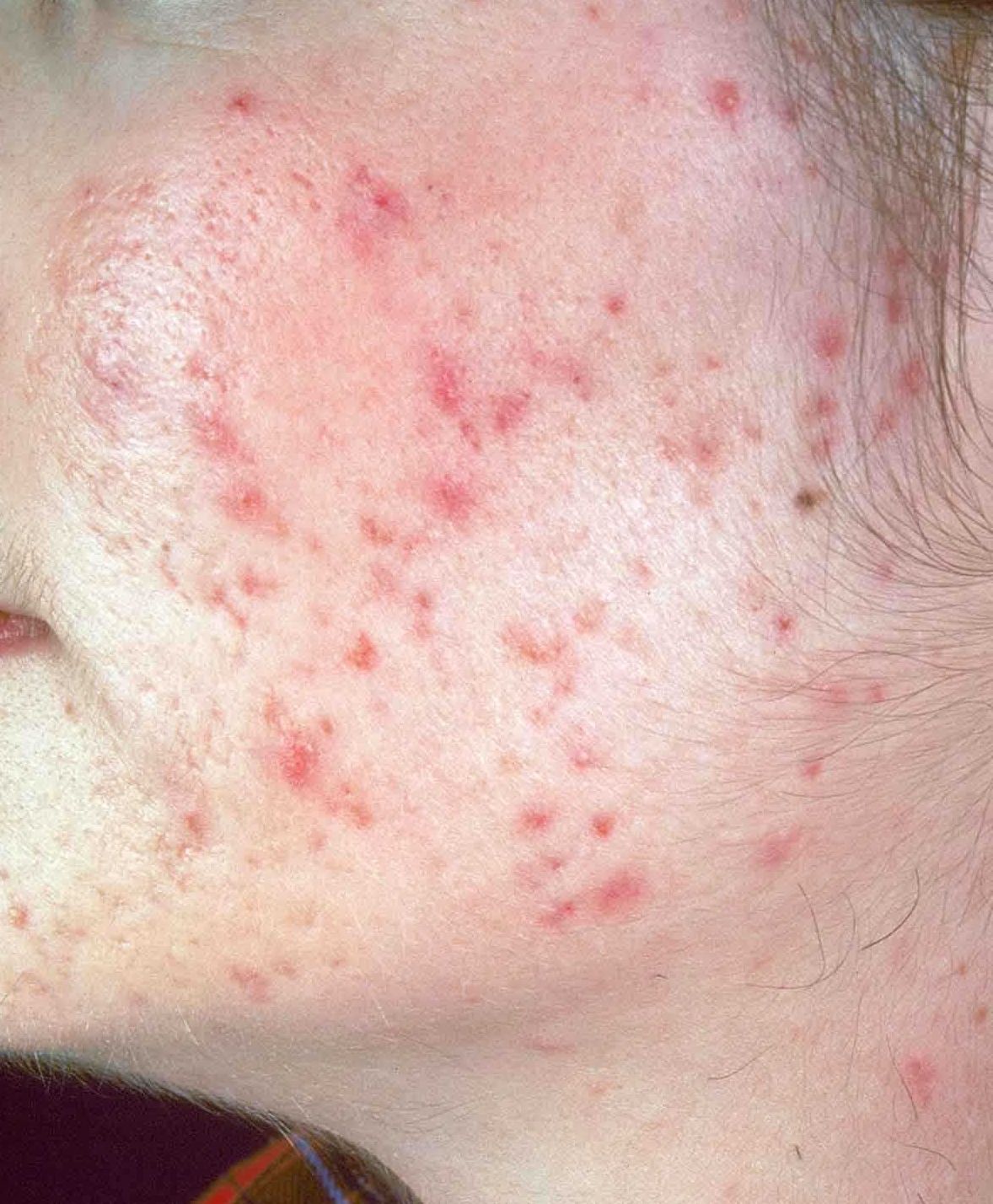 home remedy How To Get Rid Off Acne