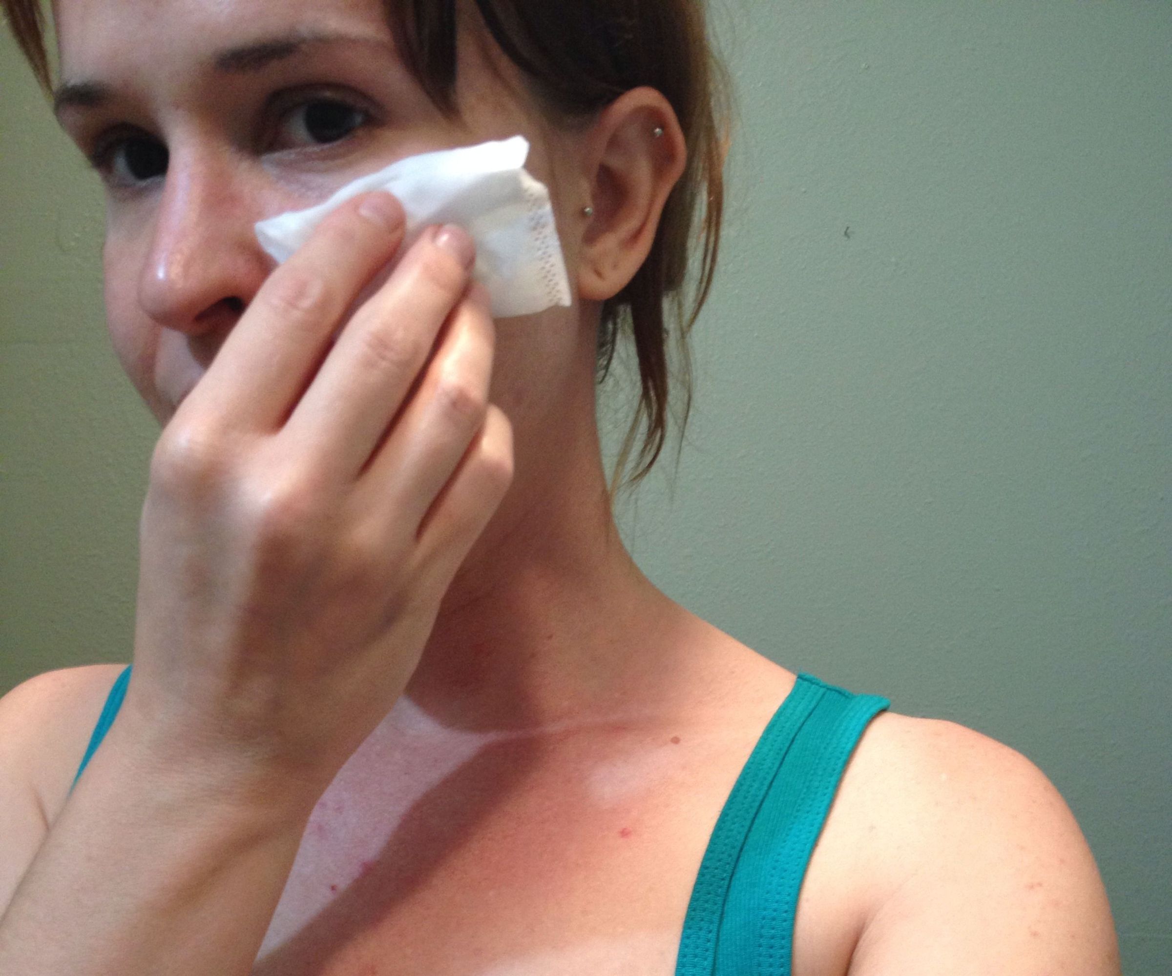 How to Treat Acne With Ice