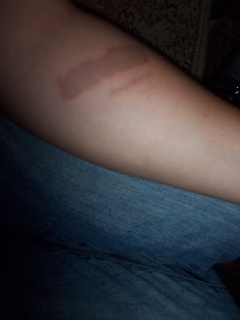 Human Freeze Branding