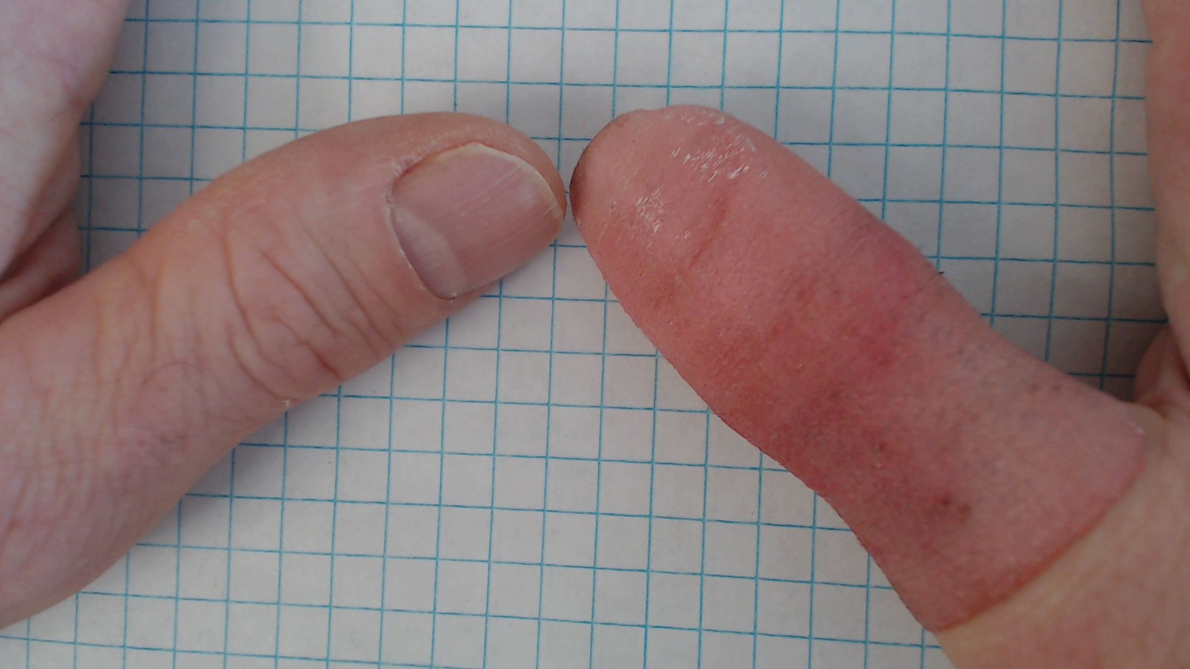 Thumb Prosthesis