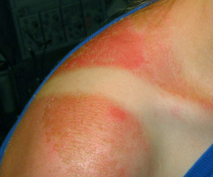 La Manera Más Eficaz De Deshacerse De Una Quemadura De Sol