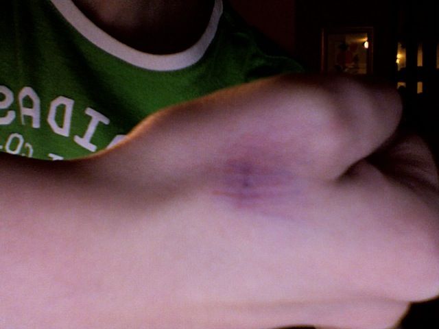 How to Fake a Bruise