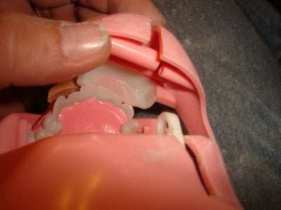 Jaw Removal