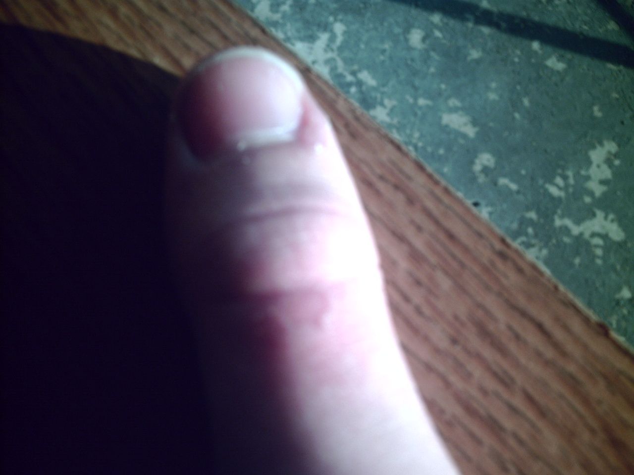 How to Treat a Minor Burn