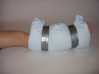 How to Splint a Broken Leg or an Ankle