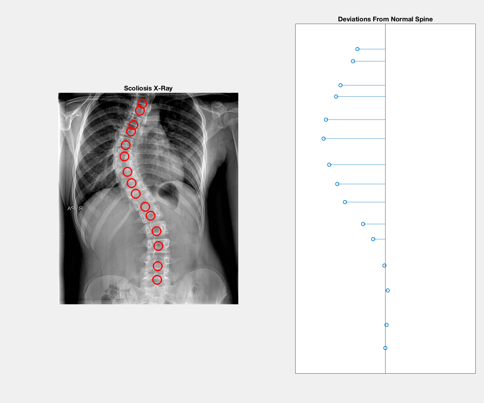 Analysis of Scoliosis X-Rays and Spinal Deviation