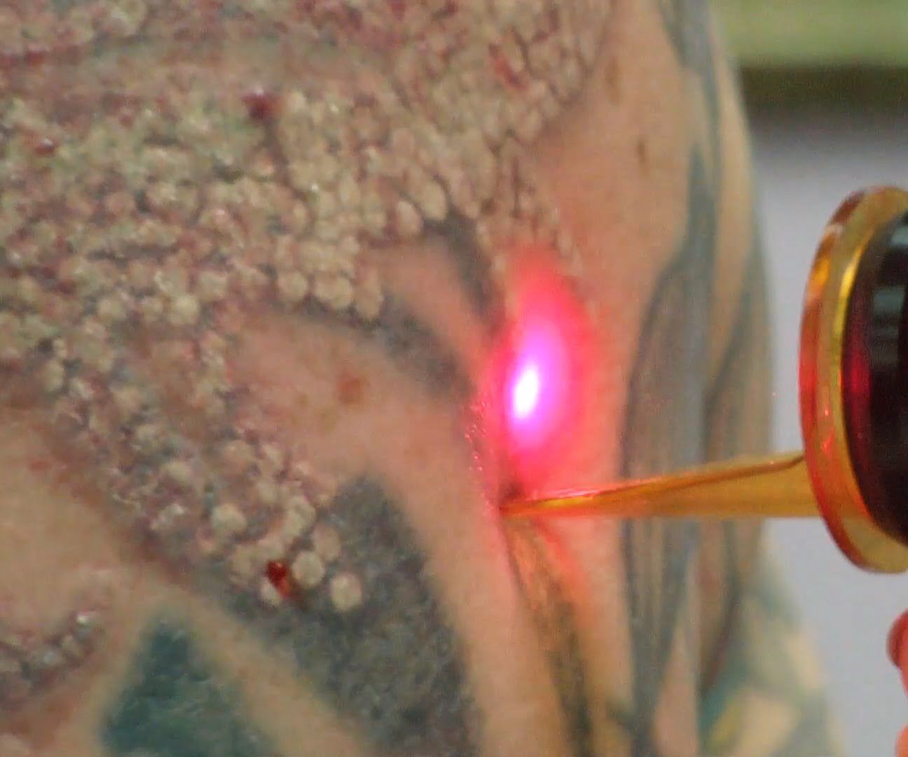 3 Ways to Remove Tattoo