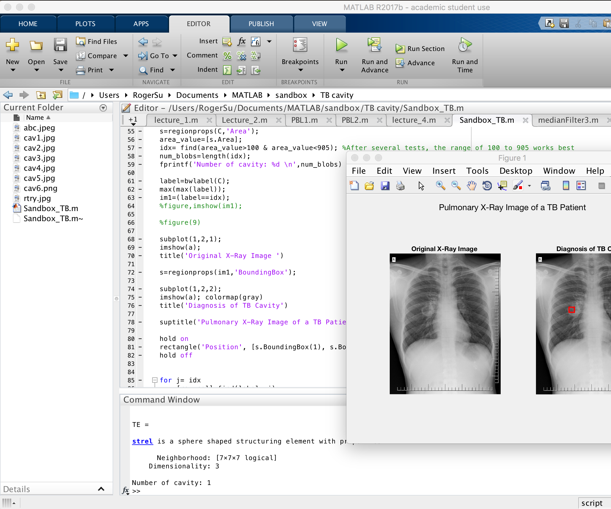 Tuberculosis X-Ray Image Processing