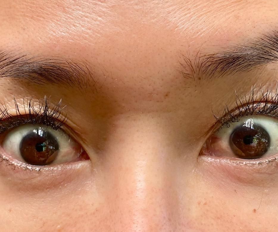 Relieve Symptoms of Trypophobia Through Exposure Therapy