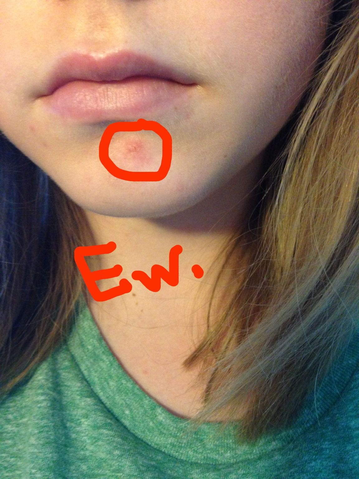 How to Cover Acne