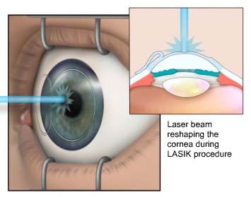 Know About  Lasik Eye Surgery in India