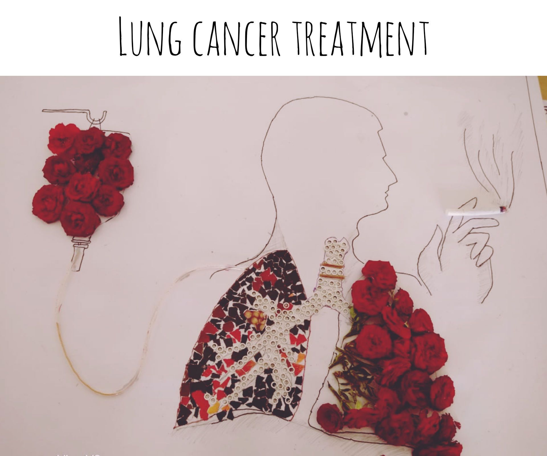 Lung Cancer Treatment - Collage Art