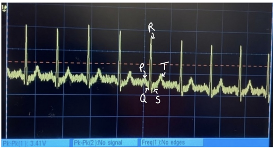 Analog Circuit Design for an ECG Measurement System